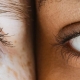 Dry Eye